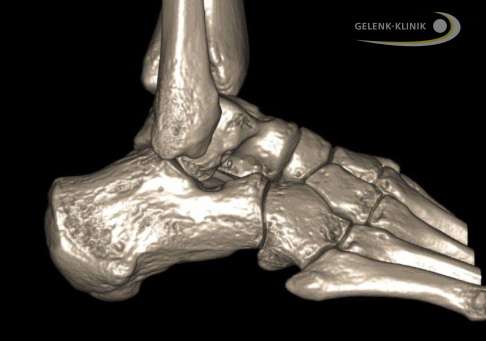 3-D-Aufnahme des Hohlfußes mit dem DVT (digitale Volumentomografie). Vor allem vor Operationen des Hohlfußes ist eine DVT-Aufnahme hilfreich, um ein vollständiges Bild der Knochen und Gelenke im Fuß zu erhalten. © Gelenk-Klinik DVT eines Hohlfußes