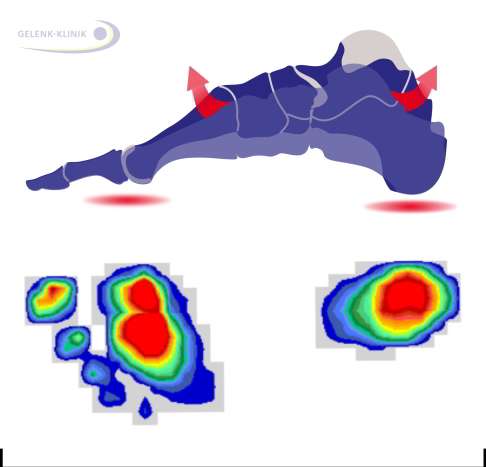 Fußabdruckmuster eines Hohlfußes