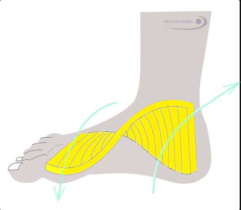 Das Spiralmodell des Fußes verdeutlicht die grundsätzliche Beziehung von Rückfuß und Vorfuß. Beim Hohlfuß ist diese Spirale viel stärker verdreht. © Gelenk-Klinik Spiralmodell des Fußes
