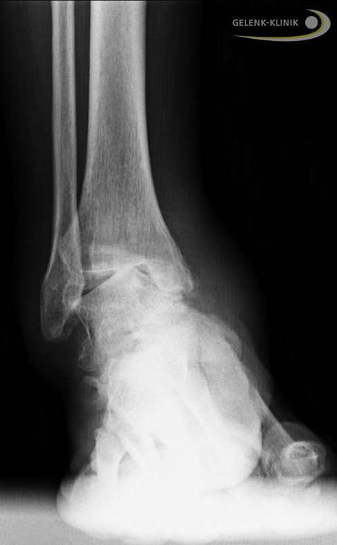 Die obere Sprunggelenksarthrose mit instabilem Außenband wird häufig von einem Hohlfuß begleitet. © Gelenk-Klinik Röntgen Sprunggelenksarthrose