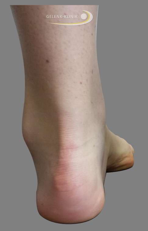 Medialer Ballenhohlfuß: Typisch für den Hohlfuß ist das hohe Fußgewölbe, das in geschlossenen Schuhen Druckschmerzen verursacht. Die Steilstellung der Mittelfußknochen löst Mittelfußschmerzen (Metatarsalgie) aus und führt zu Krallenzehen. © Gelenk-Klinik Ballenhohlfuß von hinten