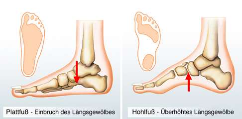 Der Plattfuß (Senkfuß) und der Hohlfuß unterscheiden sich in der Stellung des Fußlängsgewölbes. Beim Plattfuß ist das Fußlängsgewölbe abgesenkt. Beim Hohlfuß ist das Fußlängsgewölbe angehoben, der Rist des Fußes ist stark nach oben gewölbt. Entsprechend ändert sich der Fußabdruck: Beim Plattfuß liegt die gesamte Fußsohle auf dem Boden auf. Beim Hohlfuß sind nur die Abdrücke von Vorfuß und Ferse zu erkennen. Im Vergleich zum Plattfuß oder zum normalen Fußgewölbe ist der Hohlfuß insgesamt verkürzt. ©Henrie @fotolia Unterschied Plattfuß und Hohlfuß