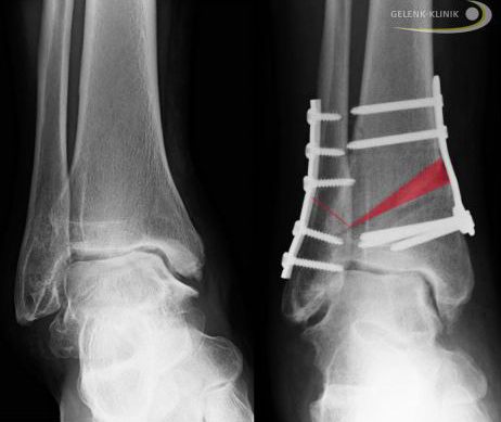 Bei einer Verdrehung des Sprungbeins (Talus) wird der Knorpel einseitig belastet. Knorpelschäden und Arthrose im Sprunggelenk sind die Folge. Durch Begradigung wird das Sprunggelenk wieder in Beinachse ausgerichtet. Die einseitige Abnutzung der Gelenke wird durch die Osteotomie beendet. © Gelenk-Klinik Röntgen: mit Schrauben fixiertes Sprunggelenk