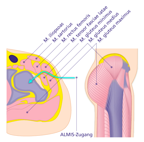 Der ALMIS-Zugang beim Einsatz einer Hüftprothese nutzt die natürliche Muskellücke zwischen dem Musculus gluteus medius und dem Musculus tensor fasciae latae. © Gelenk-Klinik ALMIS-Zugangsweg beim minimalinvasiven Einsatz einer Hüftprothese