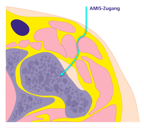 Bei der AMIS-Methode liegt der Patient in Rückenlage. AMIS ist die Abkürzung für Anterior Minimally Invasive Surgery. © Gelenk-Klinik AMIS-Zugang beim minimalinvasiven Einsatz einer Hüftprothese