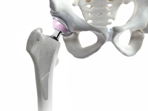 Gelenkprothesen sind künstliche Implantate, die die Gelenkfunktion wiederherstellen sollen. © ARTIQO Vollprothese der Hüfte