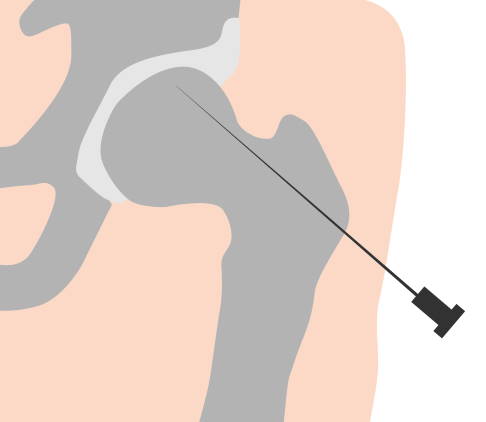 Die Anbohrung des Femurkopfes reduziert den Druck im Knochen. Auf diese Weise kann die Durchblutung wiederhergestellt werden. © Gelenk-Klinik Anbohrung des Hüftkopfes bei Hüftkopfnekrose