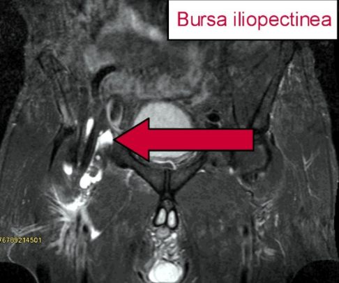 MRT-Bild einer Bursitis iliopectinea: Der Pfeil deutet auf den entzündeten Schleimbeutel. Da er mit entzündlicher Flüssigkeit gefüllt ist, erscheint der Schleimbeutel in der Bildgebung weiß. © Gelenk-Klinik MRT-Bild einer Bursitis iliopectinea in der Leistenregion