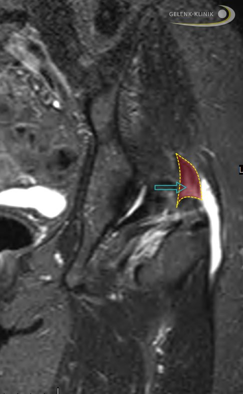 Gerissene Sehne des Gluteus medius (mittlerer Gesäßmuskel) im MRT: Der Sehnenriss (Markierung) hat zu einer starken Entzündung des Schleimbeutels über dem Trochanter major (großer Rollhügel) geführt. Der mit entzündlicher Flüssigkeit gefüllte Schleimbeutel zeigt sich im MRT als weiße Fläche. © Gelenk-Klinik Sehnenruptur des Gluteus medius mit Schleimbeutelentzündung (Bursitis trochanterica)