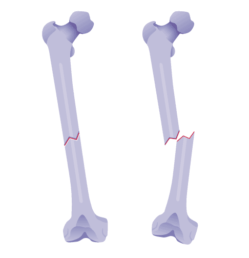 Eine Fraktur kann disloziert (verschoben) oder unverschoben auftreten. © Gelenk-Klinik Fraktur des Femurs