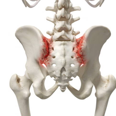 Hüftschmerzen können als ausstrahlende Schmerzen aus anderen Bereichen entstehen. Die Arthritis des Iliosakralgelenks (Verbindung zwischen Kreuz- und Darmbein) verursacht stechende und bewegungsabhängige Schmerzen im Bereich des Hüftgelenks © Sebastian Kaulitzki @ fotolia Hüftschmerzen durch Sakroiliitis