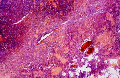 Faserknorpel unter dem Mikroskop: Im Vergleich zum hyalinen Knorpel sind weniger Chondrozyten sichtbar. Der Aufbau des Ersatzknorpels ist durch Kollagenfasern gekennzeichnet. © Josep Maria Barres, iStock Faserknorpel unter dem Mikroskop