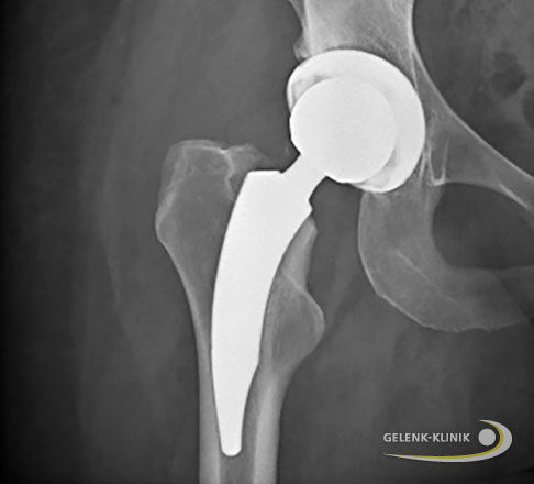 Bei der Patientin sind beide Gelenkanteile der rechten Hüfte von Arthrose betroffen. Daher ersetzt der Orthopäde das rechte Hüftgelenk durch eine Hüft-Totalendoprothese. Hier wählte er eine Kurzschaftprothese. © Gelenk-Klinik Hüft-TEP bei einseitiger Hüftarthrose wegen Hüftdysplasie.