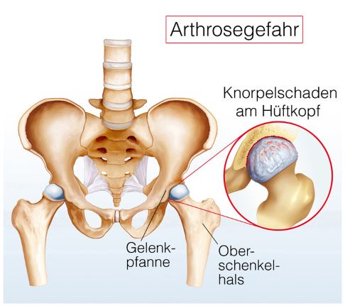 Eine schwere Hüftarthrose kann dazu führen, dass sich Knorpelstücke aus dem Gelenk lösen. In einer Hüftarthroskopie kann der Arzt solche freien Gelenkkörper entfernen. © Henrie, Fotolia Schematisches Bild einer Hüftarthrose