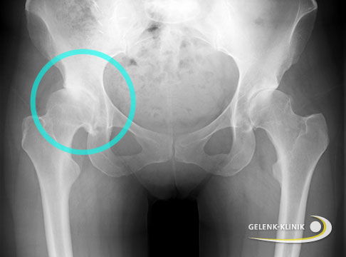 Röntgenbild einer erwachsenen Frau mit ausgeprägter Hüftarthrose (Coxarthrose) rechts aufgrund bestehender Hüftdysplasie. Der Oberschenkelkopf (Femurkopf) und die Gelenkpfanne (Acetabulum) zeigen deutliche Verschleißerscheinungen. © Gelenk-Klinik Röntgenbild einer einseitigen Hüftarthrose wegen Hüftdysplasie.