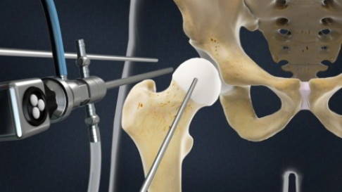 Hüftschmerzen, die durch eine Beschädigung der Gelenklippe (Labrum acetabulare) oder eine Fehlform des Hüftgelenks entstehen, können mithilfe der minimalinvasiven Hüftarthroskopie operiert werden. Dabei werden Sichtgeräte und operative Instrumente durch einen endoskopischen (minimalinvasiven) Zugang in das Gelenk eingeführt. © Viewmedica Hüftarthroskopie bei Hüftimpingement