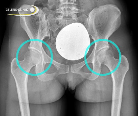 Das Röntgenbild zeigt eine beidseitige Hüftdysplasie bei einer 45-jährigen Patientin. Die Gelenkpfanne (Acetabulum) überdacht den kugeligen Oberschenkelkopf nur unzureichend. Der Oberschenkelknochen ist dadurch nicht fest und zentriert im Hüftgelenk verankert.© Gelenk-Klinik Röntgenbild beidseitige Hüftdysplasie bei erwachsener Patientin