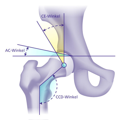 Zur Beurteilung einer Restdysplasie bei Erwachsenenhüften ermittelt der Orthopäde mithilfe von Röntgenaufnahmen drei wichtige Winkelmaße: den CCD-Winkel als Maß für die Belastbarkeit des Hüftgelenks sowie den CE- und AC-Winkel als Maß für die Überdachung des Hüftkopfes durch die Pfanne. © Gelenk-Klinik Kombinierte Darstellung der mittels Röntgenbild bestimmten Winkel zur Beurteilung einer Hüftdysplasie bei Erwachsenen