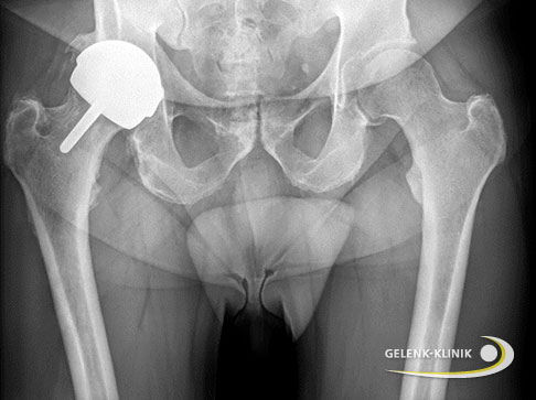Beim Oberflächenersatz nach McMinn (McMinn-Prothese oder Hüftkappe) überkront die Teilprothese den arthrotisch geschädigten Hüftkopf. Die Oberflächenersatzprothese ist knochensparender und schonender als eine Hüft-Totalendoprothese. © Gelenk-Klinik Hüft-Teilprothese McMinn.