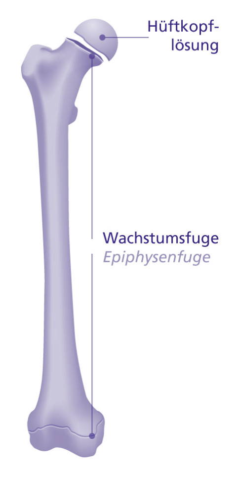 Bei einer Hüftkopflösung ist der Knochen im Bereich der Wachstumsfuge geschwächt. Der Hüftkopf löst sich vom Schenkelhals. © Gelenk-Klinik Hüftkopflösung