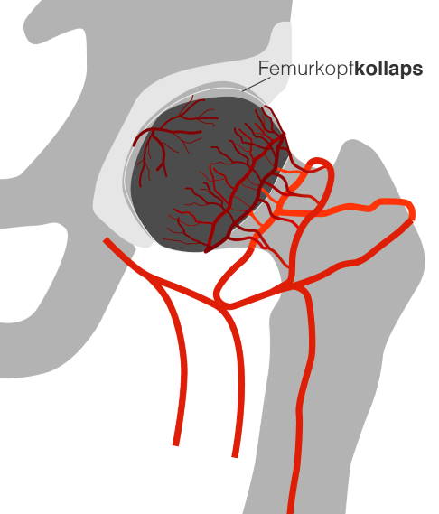 Durch eine Minderdurchblutung wird der Hüftkopf nicht mehr ausreichend mit Nährstoffen versorgt. Es kommt zu einer Hüftkopfnekrose. Im schlimmsten Fall kann der Knochen unter der Knorpelfläche des Hüftgelenkes einbrechen. © Gelenk-Klinik Einbruch des Oberschenkelkopfes aufgrund der Nekrose