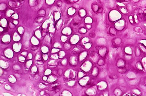 Hyaliner Gelenkknorpel unter dem Mikroskop: Gut sichtbar sind die Chondrozyten (Knorpelzellen), die von der Knorpelmatrix umgeben werden. © Josep Maria Barres, iStock Hyaliner Gelenkknorpel unter dem Mikroskop