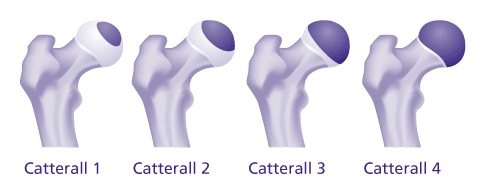 Catterall-Klassifikation: In höheren Krankheitsstadien ist ein größerer Anteil des Hüftkopfes betroffen. © Gelenk-Klinik Catterall-Klassifikation zur Einschätzung des Stadiums bei Morbus Perthes