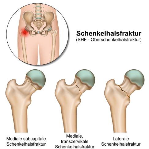 Der Oberschenkelhals kann an verschiedenen Stellen brechen: direkt unter dem Hüftkopf (subcapital), mittig (transzervikal) oder körperfern (lateral). Die nachfolgende Behandlung ist abhängig von der Art des Bruches. © bilderzwerg, Adobe Stock Arten des Oberschenkelhalsbruches