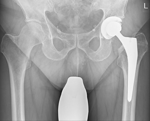 Ein jüngerer Mann mit Oberschenkelhalsbruch erhielt eine zementfreie Kurzschaftprothese, da die vorangegangene Osteosynthese bei ihm zur Pseudarthrose führte. © Gelenk-Klinik Hüftprothese nach Oberschenkelhalsbruch