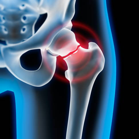 Der Oberschenkel ist über den Oberschenkelhals mit dem Hüftgelenk verbunden. Eine Oberschenkelhalsfraktur bei alten Menschen weist häufig auf eine Osteomalazie oder eine Osteoporose hin. © peterschreiber.media, Adobe Stock Oberschenkelhalsbruch
