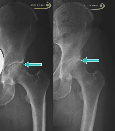 Links das Röntgenbild eines gesunden Hüftgelenks. Der Gelenkspalt ist deutlich zu erkennen (Pfeil). Rechts bei einem Patienten mit Coxarthrose ist der Gelenkspalt aufgrund des Knorpelabbaus deutlich verschmälert und die Knochen reiben schmerzhaft aufeinander. © Gelenk-Klinik Röntgenbild einer schweren Coxarthrose (rechts) im Vergleich zum gesunden Hüftgelenk (links)