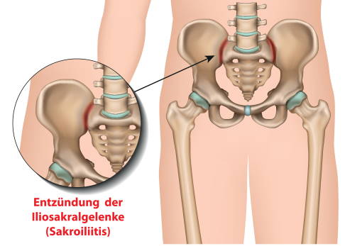 Die meist einseitige Entzündung der Iliosakralgelenke nennt man Sakroiliitis. Sie tritt beispielsweise im Rahmen einer rheumatischen Grunderkrankung auf. © bilderzwerg, Adobe Entzündung der Iliosakralgelenke (Sakroiliitis)