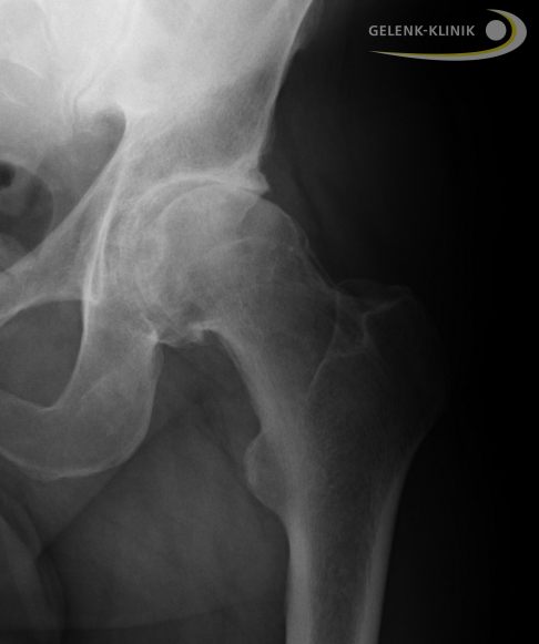 Unter Gewichtsbelastung im Stehen lässt sich eine Coxarthrose im Röntgen gut erkennen. Durch den Knorpelverlust ist der Gelenkspalt verschmälert. © Gelenk-Klinik Röntgenbild einer Coxarthrose mit sichtbar verschmälertem Gelenkspalt