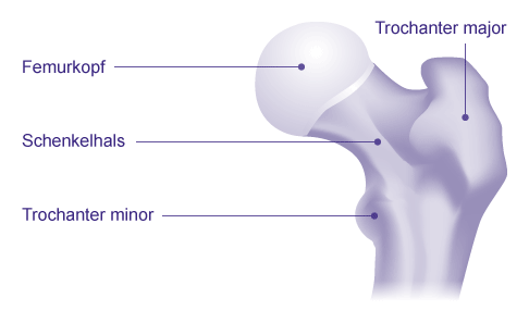 Am Trochanter major auf der Außenseite des Oberschenkelknochens befindet sich der am häufigsten entzündete Schleimbeutel am Hüftgelenk. © Gelenk-Klinik Anatomie: Trochanter major und Trochanter minor am Oberschenkelknochen (Femur)