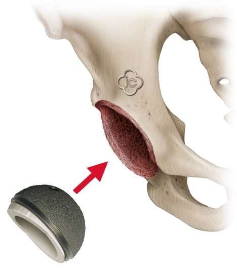 Zunächst säubert der Arzt die Gelenkpfanne (Acetabulum). Die künstliche Gelenkpfanne aus Metall wird dann in den Beckenknochen eingeklemmt (Press-Fit-Verfahren), sodass sie sofort belastbar ist. © Implantcast Press-Fit-Verfahren zur Verbindung der künstlichen Gelenkpfanne mit dem Beckenknochen