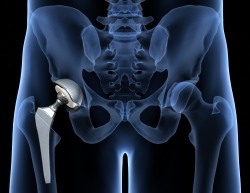 Heute halten viele Hüftprothesen 20 bis 25 Jahre. In manchen Fällen ist die Lebensdauer jedoch kürzer. Der Wechsel einer gelockerten oder verschlissenen Hüftprothese heißt Hüftprothesenrevision. © Viewmedica Hüft-TEP (Totalendoprothese der Hüfte)