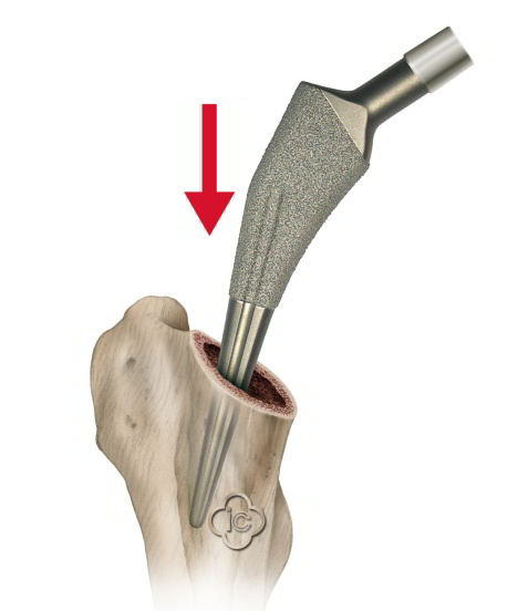 Schematische Darstellung der Implantation einer Hüftendoprothese