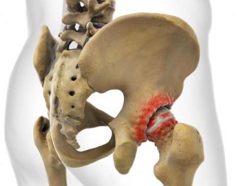 Hüftschmerzen als Folge der Hüftarthrose. Der Gelenkverschleiß verändert Knorpel und Knochen des Hüftgelenks. © Viewmedica Hüftschmerzen durch Arthrose des Hüftgelenks