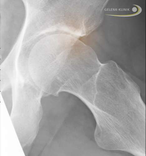 Hüftgelenk mit Cam-Impingement. Das Cam- oder Nockenwellen-Impingement ist eine knöcherne Erhöhung am Oberschenkelkopf, die an die Hüftpfanne (Acetabulum) anschlägt (rot eingezeichnet). © Gelenk-Klinik.de Röntgenbild Cam-Impingement