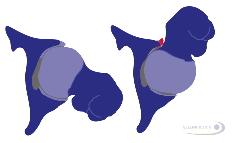 Links: normales Hüftgelenk. Rechts: Hüftgelenk mit Pincer-Impingement. Beim Pincer-Impingement ist die Hüftgelenkspfanne vertieft und schlägt an den Oberschenkelkopf an (rot). © Gelenk-Klinik Grafik Pincer-Impingement
