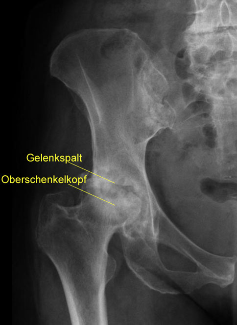 Röntgenbild einer Hüftarthrose: Der Gelenkspalt, der im gesunden Hüftgelenk durch Knorpel gebildet wird, ist komplett verschwunden. Die Knochen des Oberschenkelkopfes und der Hüftpfanne liegen im Gelenk direkt aufeinander. Durch die Last der direkt aufeinanderreibenden Gelenkflächen entsteht eine subchondrale Sklerosierung, eine verstärkte Knochenbildung an den Gelenkflächen, die im Röntgen als weiße Aufhellung sichtbar ist. Röntgenbild einer Coxarthrose