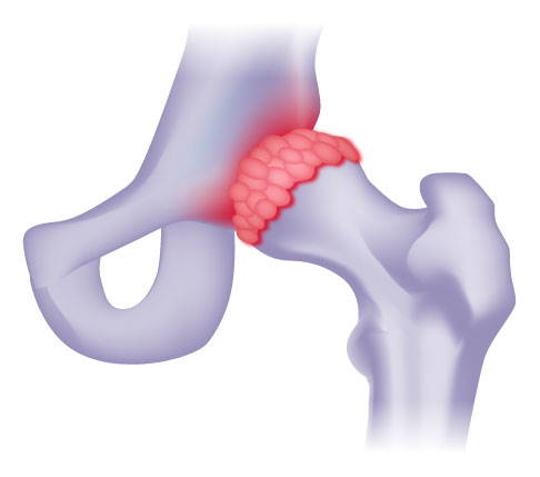Eine Coxitis (Entzündung des Hüftgelenks) kann bakteriell (durch Keime) oder abakteriell verursacht werden. © Gelenk-Klinik Entzündetes Hüftgelenk (Coxitis)