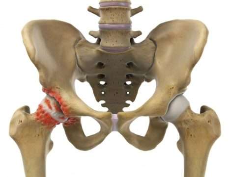 Je stärker die Knorpelfläche abgenutzt ist, umso deutlicher neigt das Hüftgelenk dazu, sich durch die Bildung von Knochenanbauten selbst zu versteifen. Diese Osteophyten bilden sich auf dem Oberschenkelkopf und in der Hüftgelenkspfanne(rot). Die knöchernen Anbauten reduzieren die Beweglichkeit im Hüftgelenk zusätzlich. Knorpelabbau und Arthrose verstärken sich. Im Frühstadium kann es helfen, diese Osteophyten am Oberschenkelkopf operativ im Rahmen einer Hüftarthroskopie abzutragen. © Istockphoto Hüftarthrose mit Osteophyten (Knochenspornen)
