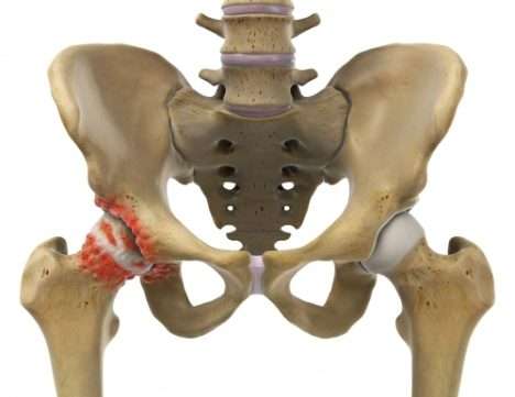 Hüftarthrose mit Osteophyten (Knochenspornen)