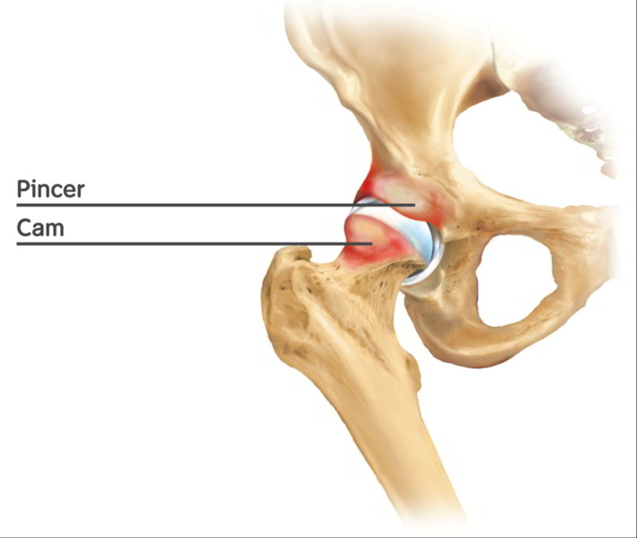 Hüftgelenk mit kombiniertem Cam-Impingement am Oberschenkelkopf und Pincer-Impingement an der Hüftgelenkspfanne. © Istockphotos Bild: Impingement der Hüfte, Schema Cam-Impingement, Pincer-Impingement