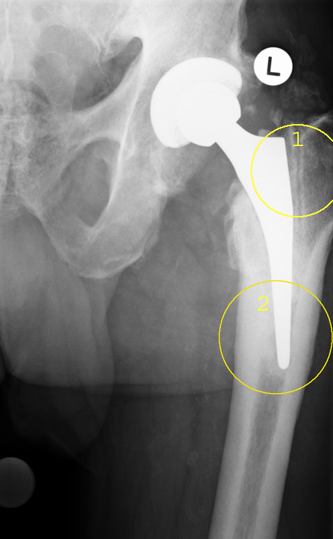 Hüftprothese Fehlplanung