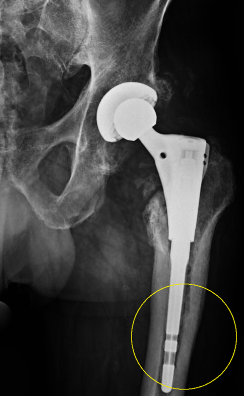 Gleicher Patient: Die Implantation einer Langschaftprothese hat die Geometrie der zementierten Hüftprothese korrigiert. So nutzt die tief verankerte Prothese die gesamte Tragfähigkeit des Oberschenkelknochens besser aus. © Dr. Martin Rinio Hüftprothese Revision