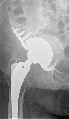 Selbe Patientin: Ein spezielles Pfannenimplantat hat die Hüftpfanne wieder stabilisiert. Der Knochen wurde mithilfe von keramischem Knochenersatz wieder aufgebaut, sodass der geschwächte Knochen wieder regenerieren kann. Die große Halbschale ist ein Knochenersatz aus Metall mit einem zusätzlichen Abstützring. Dieser dient der besseren Verankerung der neuen Hüftpfanne. © Dr. Martin Rinio Stabilisierung des Pfannenbruchs der Hüftprothese
