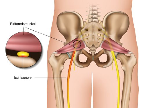 Erklärung des Piriformis-Syndroms