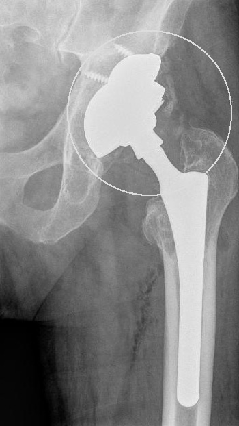 Wenn eine aseptische Osteolyse (Knochenschwund) die Knochensubstanz im Bereich der Gelenkpfanne geschwächt hat, muss die erneute Befestigung diese Schwachstelle ausgleichen. Bei dieser Patientin wurde die Gelenkpfanne über einen Sockel im Beckenknochen verankert und zusätzlich verschraubt. © Dr. Martin Rinio Befestigung der Hüftpfanne mit Sockelpfanne